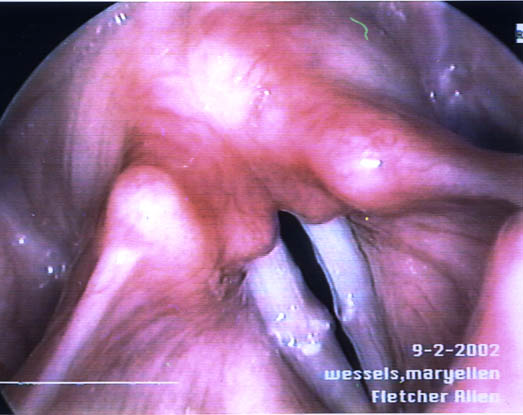 Vocal Nodules Pictures